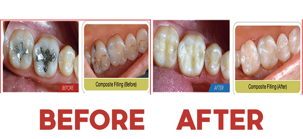 Restoration With Fillings