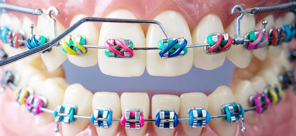 Orthodontic Treatment